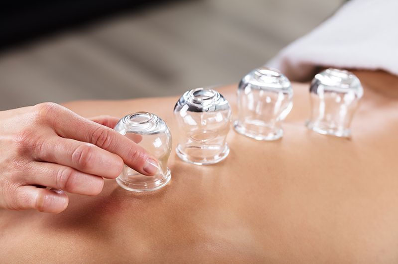 Cupping Massage in Naples, Florida